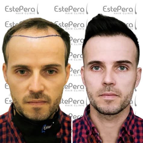 Clinica Trapianto Capelli Turchia .